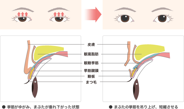 挙筋がゆがみ、まぶたが垂れ下がった状態VSまぶたの挙筋を吊り上げ、短縮させる