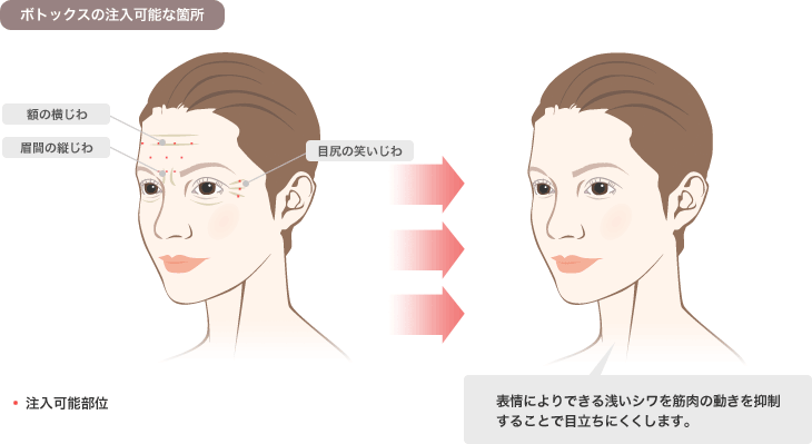 ボトックスの注入可能な箇所