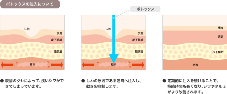 ボトックスの注入について