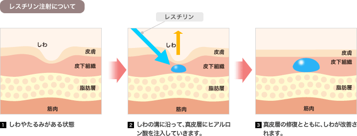 レスチリン注射について