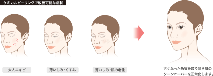 ケミカルピーリングで改善可能な症状