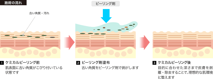 施術の流れ