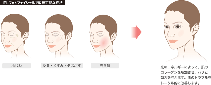 IPLフォトフェイシャルで改善可能な症状