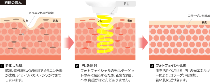 施術の流れ