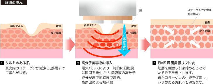 施術の流れ