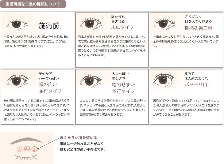 施術可能な二重の種類について