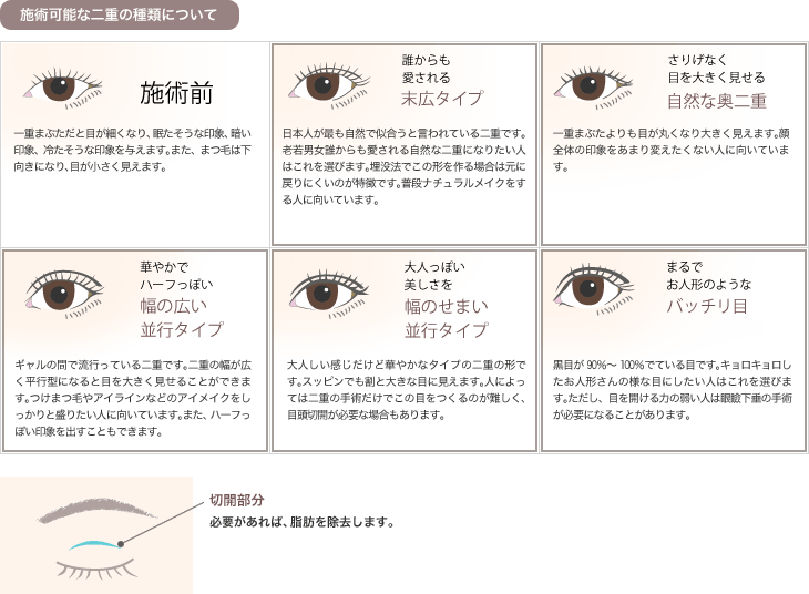 施術可能な二重の種類について