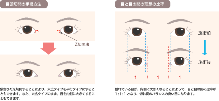 目頭切開の手術方法 目と目の間の理想の比率
