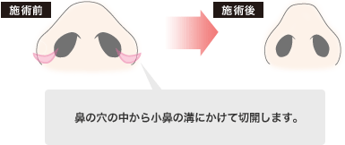 目頭切開の手術方法 目と目の間の理想の比率