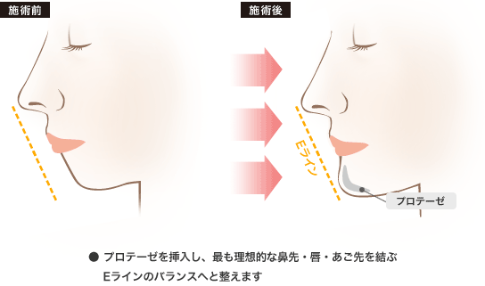 プロテーゼを挿入し、最も理想的な鼻先・唇・あご先を結ぶEラインのバランスへと整えます