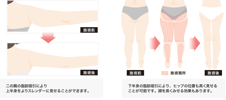 二の腕の脂肪吸引により上半身をよりスレンダーに見せることができます。