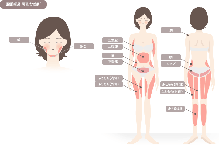 脂肪吸引可能な箇所