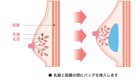 乳腺と筋膜の間にバッグを挿入します