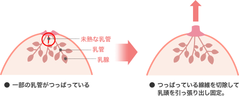 一部の乳管がつっぱっている つっぱっている乳管を切除して乳頭を引っ張り出し固定。