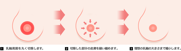 乳輪周囲を丸く切除します。 切除した部分の皮膚を縫い縮めます。 理想の乳輪の大きさまで縮小します。