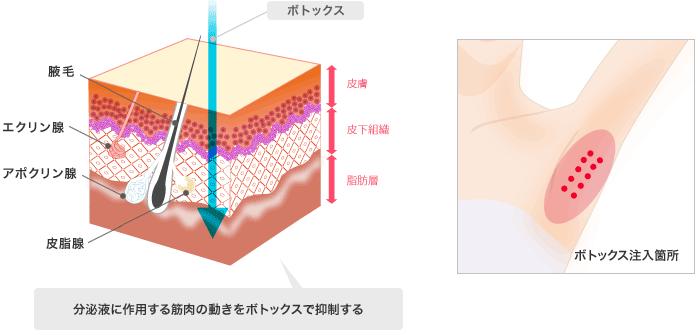 分泌液に作用する筋肉の動きをボトックスで抑制する