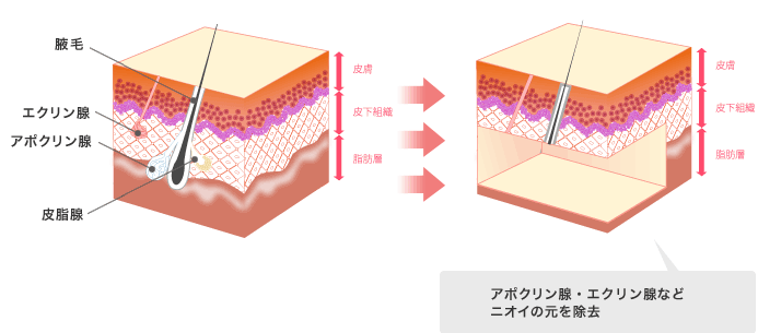 アポクリン腺・エクリン腺などニオイの元を除去