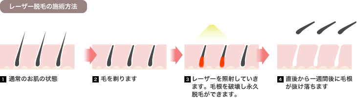 レーザー脱毛の施術方法