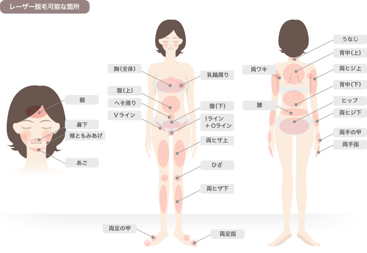 レーザー脱毛可能な箇所