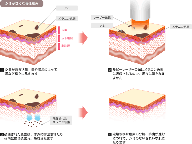 シミがなくなる仕組み