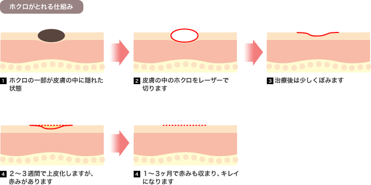 ホクロがとれる仕組み